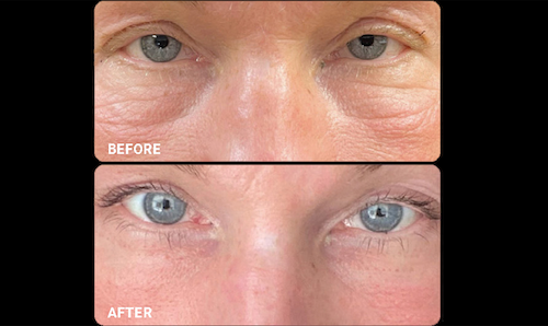 Under Eye Filler Before After Dark Circles Mississauga Oakville cop